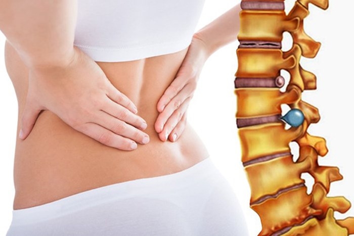 Những câu hỏi thường gặp về phình đĩa đệm