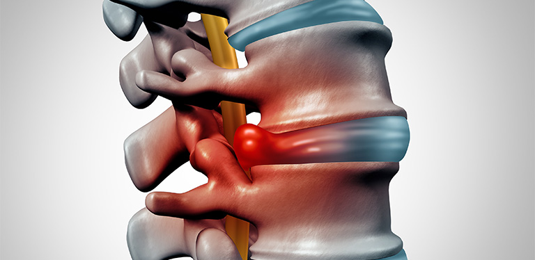 Phình đĩa đệm là gì? Triệu chứng của phình đĩa đệm